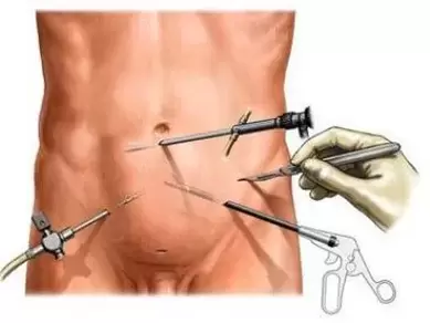 քրոնիկ պրոստատիտի վիրաբուժական բուժում